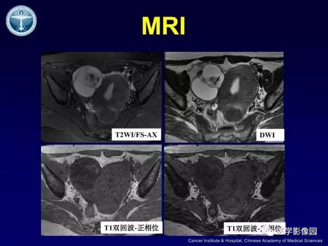 【病例】卵巢甲状腺肿1例CT及MR