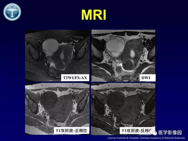 【病例】卵巢甲状腺肿1例CT及MR