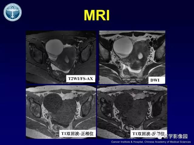 【病例】卵巢甲状腺肿1例CT及MR