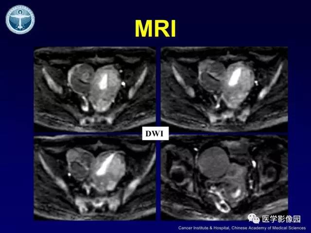 【病例】卵巢甲状腺肿1例CT及MR