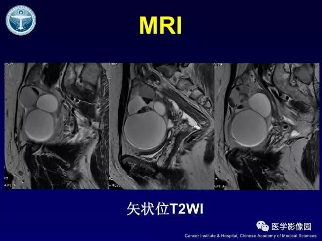 【病例】卵巢甲状腺肿1例CT及MR