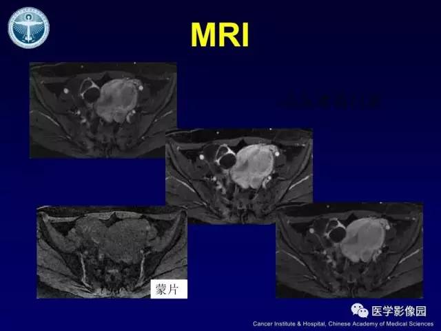 【病例】卵巢甲状腺肿1例CT及MR