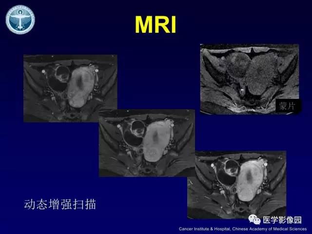 【病例】卵巢甲状腺肿1例CT及MR