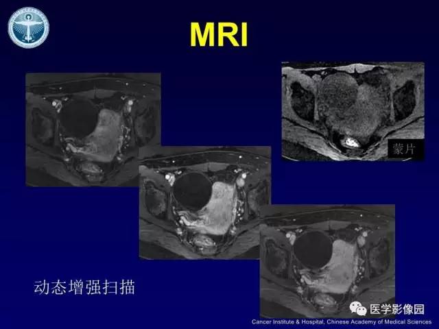 【病例】卵巢甲状腺肿1例CT及MR