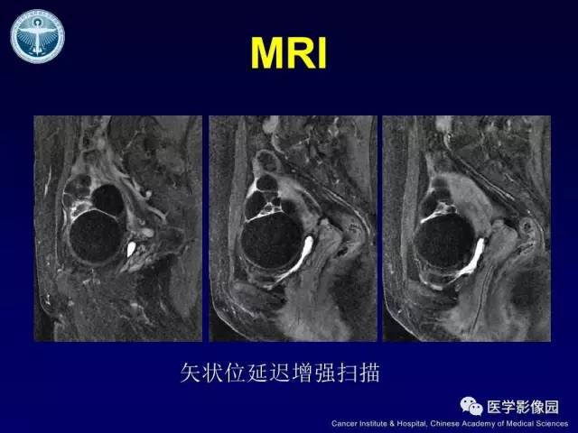 【病例】卵巢甲状腺肿1例CT及MR