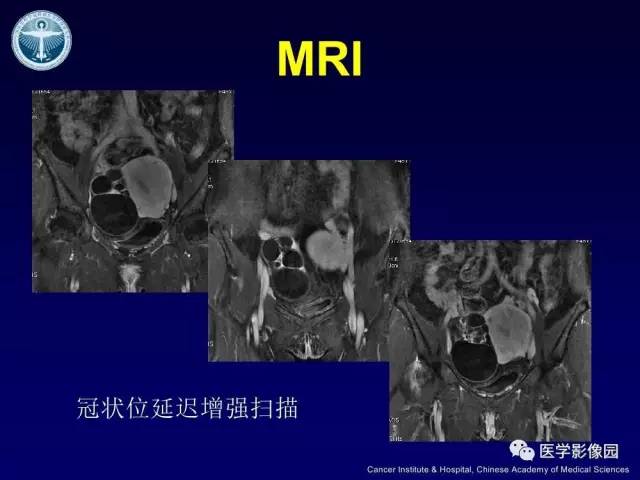 【病例】卵巢甲状腺肿1例CT及MR