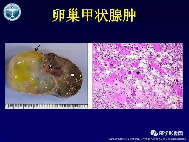 【病例】卵巢甲状腺肿1例CT及MR