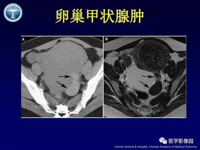 【病例】卵巢甲状腺肿1例CT及MR
