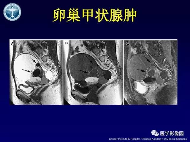 【病例】卵巢甲状腺肿1例CT及MR