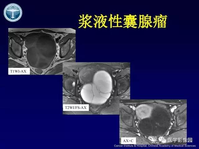 【病例】卵巢甲状腺肿1例CT及MR