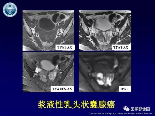 【病例】卵巢甲状腺肿1例CT及MR