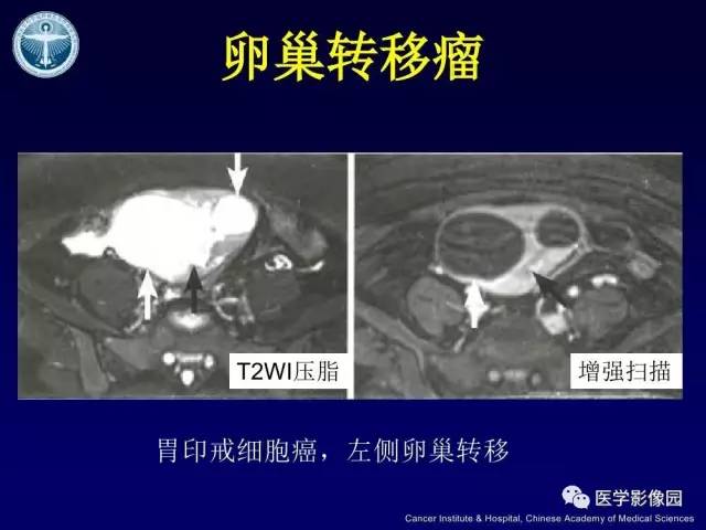【病例】卵巢甲状腺肿1例CT及MR
