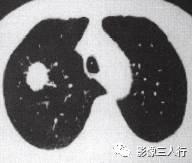 “血管切迹征” 的影像表现与临床意义 “血管切迹征” 的影像表现与临床意义
