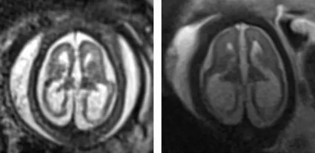 寨卡病毒感染先天性颅脑畸形影像表现