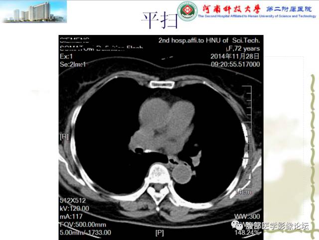 【病例】脾脏血管淋巴管瘤1例CT影像表现 【病例】脾脏血管淋巴管瘤1例CT影像表现