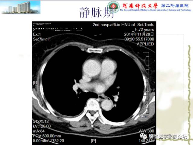 【病例】脾脏血管淋巴管瘤1例CT影像表现 【病例】脾脏血管淋巴管瘤1例CT影像表现