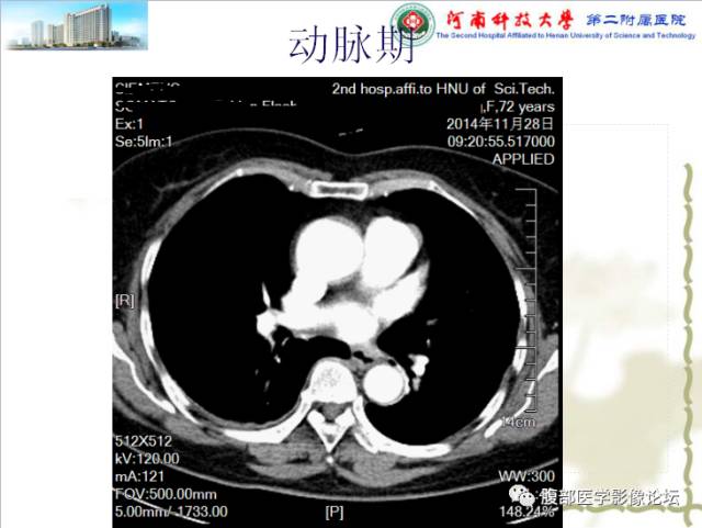 【病例】脾脏血管淋巴管瘤1例CT影像表现 【病例】脾脏血管淋巴管瘤1例CT影像表现