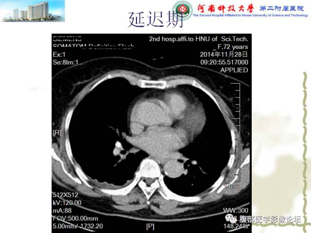 【病例】脾脏血管淋巴管瘤1例CT影像表现 【病例】脾脏血管淋巴管瘤1例CT影像表现