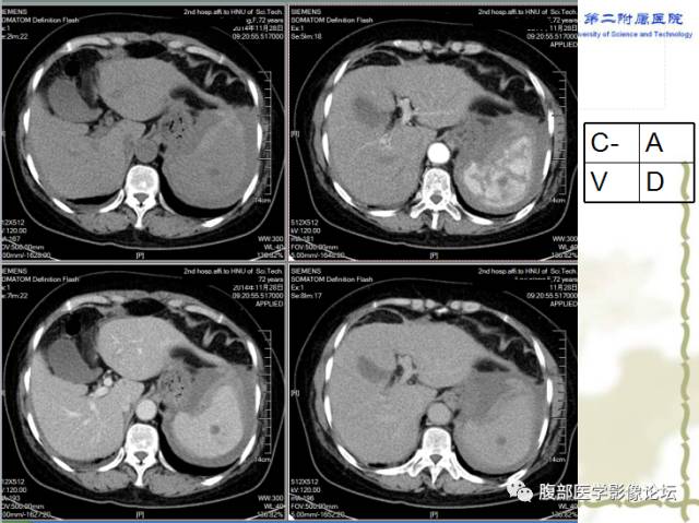 【病例】脾脏血管淋巴管瘤1例CT影像表现 【病例】脾脏血管淋巴管瘤1例CT影像表现
