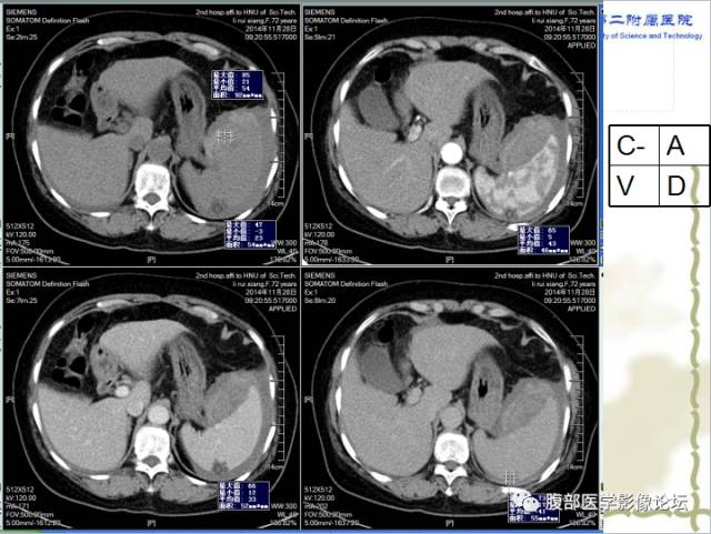 【病例】脾脏血管淋巴管瘤1例CT影像表现 【病例】脾脏血管淋巴管瘤1例CT影像表现