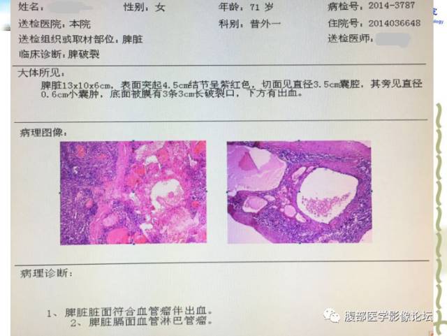 【病例】脾脏血管淋巴管瘤1例CT影像表现 【病例】脾脏血管淋巴管瘤1例CT影像表现
