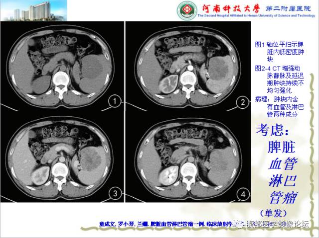 【病例】脾脏血管淋巴管瘤1例CT影像表现 【病例】脾脏血管淋巴管瘤1例CT影像表现