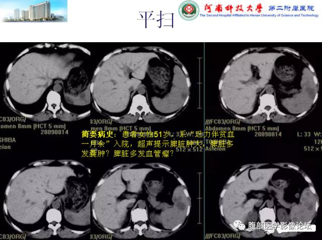 【病例】脾脏血管淋巴管瘤1例CT影像表现 【病例】脾脏血管淋巴管瘤1例CT影像表现