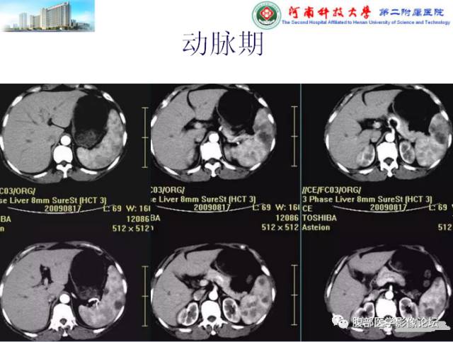 【病例】脾脏血管淋巴管瘤1例CT影像表现 【病例】脾脏血管淋巴管瘤1例CT影像表现