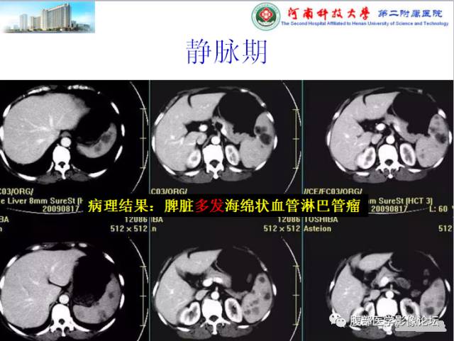 【病例】脾脏血管淋巴管瘤1例CT影像表现 【病例】脾脏血管淋巴管瘤1例CT影像表现