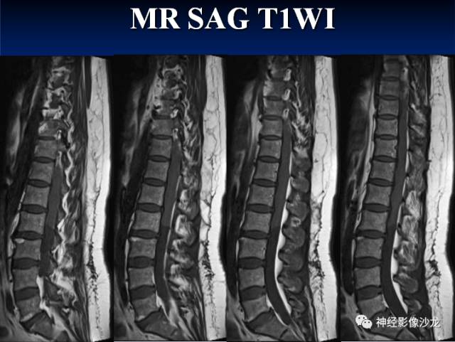 【病例】脊髓节细胞胶质瘤1例MR