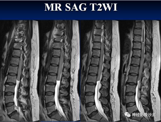 【病例】脊髓节细胞胶质瘤1例MR