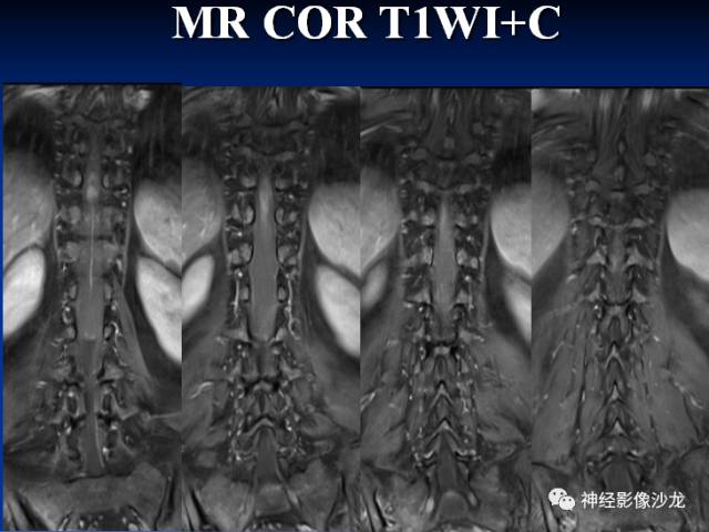 【病例】脊髓节细胞胶质瘤1例MR