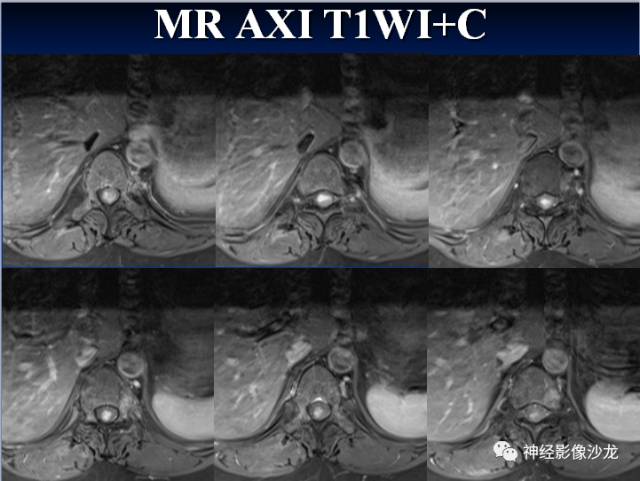 【病例】脊髓节细胞胶质瘤1例MR