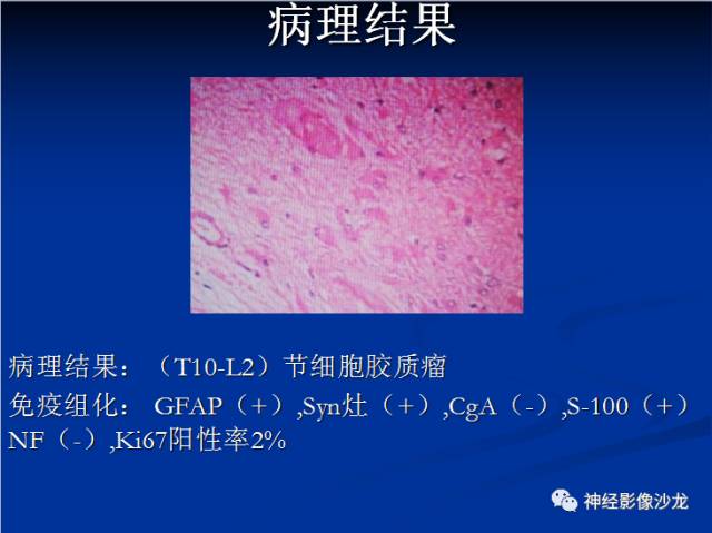 【病例】脊髓节细胞胶质瘤1例MR
