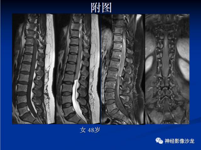 【病例】脊髓节细胞胶质瘤1例MR
