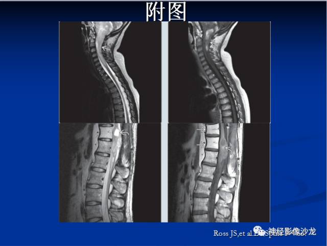 【病例】脊髓节细胞胶质瘤1例MR