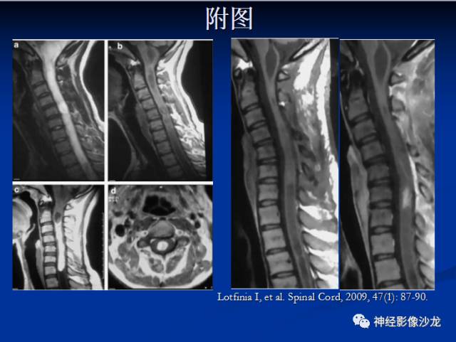 【病例】脊髓节细胞胶质瘤1例MR