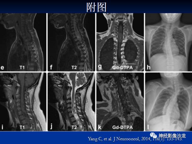 【病例】脊髓节细胞胶质瘤1例MR