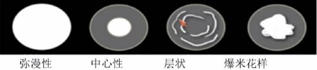 肺内孤立性结节高危CT征象 肺内孤立性结节高危CT征象