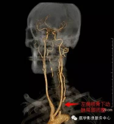 【病例】锁骨下动脉盗血综合征1例CT
