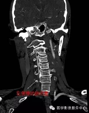 【病例】锁骨下动脉盗血综合征1例CT