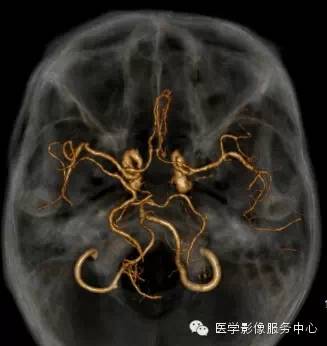 【病例】锁骨下动脉盗血综合征1例CT