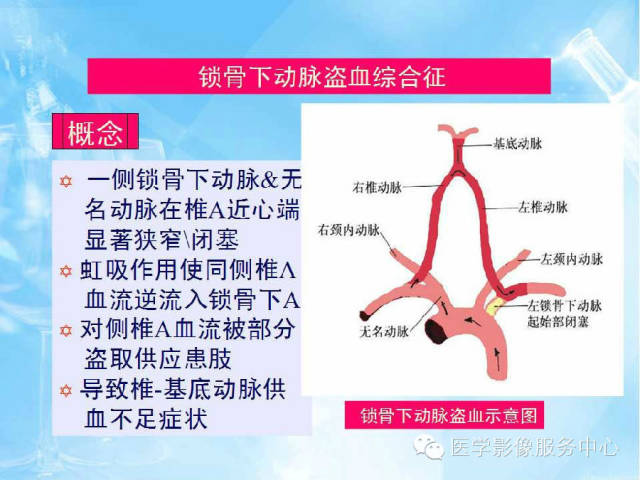 【病例】锁骨下动脉盗血综合征1例CT