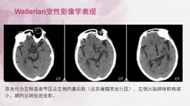 【PPT】Wallerian变性是什么？