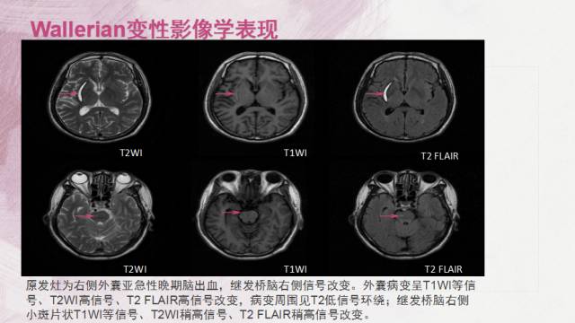 【PPT】Wallerian变性是什么？