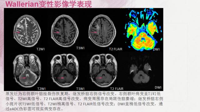 【PPT】Wallerian变性是什么？
