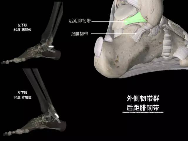 【病例】踝关节韧带解剖学
