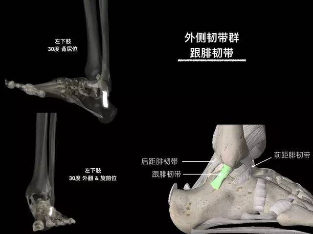 【病例】踝关节韧带解剖学