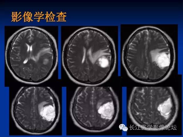 【病例】微囊型脑膜瘤1例MR影像表现与鉴别
