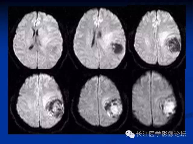 【病例】微囊型脑膜瘤1例MR影像表现与鉴别